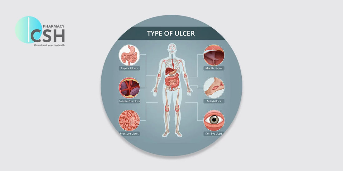 Types of Ulcers and Steps to Avoid It