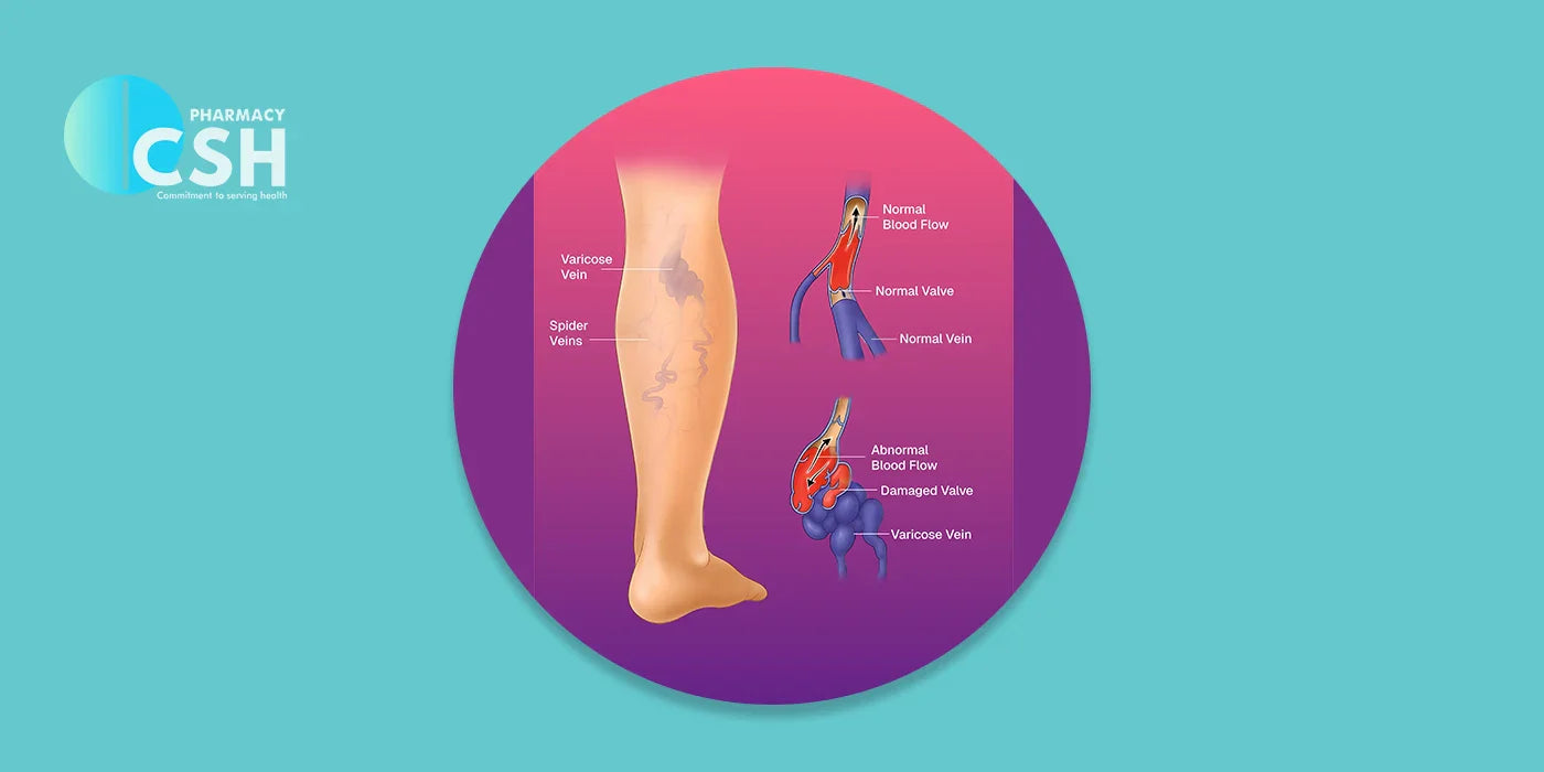 How to Fix Varicose Veins: A Comprehensive Guide to Exercises, Prevention, and Natural Remedies